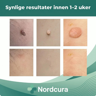 Hudflikfjerner – Komplett sett for hjemmebruk