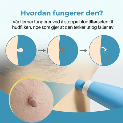 Infografikk som viser hvordan hudlappfjerneren fungerer i tre trinn – gummibåndet strammer til og hindrer blodtilførselen til hudlappene tørker ut og faller av av seg selv