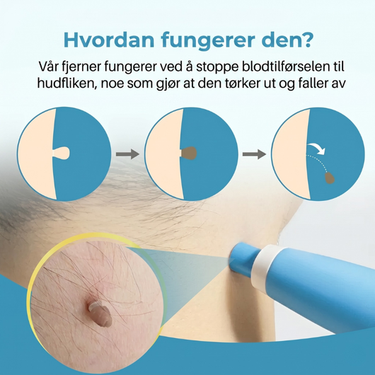 Infografikk som viser hvordan hudlappfjerneren fungerer i tre trinn – gummibåndet strammer til og hindrer blodtilførselen til hudlappene tørker ut og faller av av seg selv