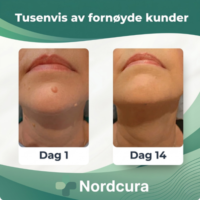 Før- og etterbilde av halsen med hudlapp på dag 1 og samme område uten hudlapp på dag 14, med teksten «Tusenvis av fornøyde kunder»
